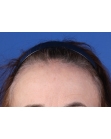 Before Hair Transplant &nbsp;Hairline